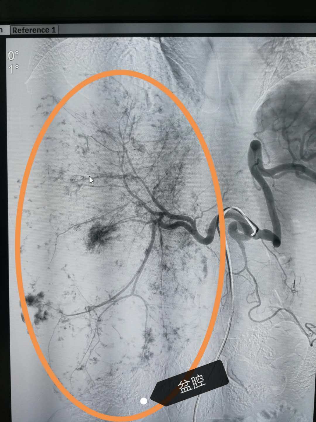 补硒能消除肺结节吗（肺能消除补结节硒元素吗）-硒宝网