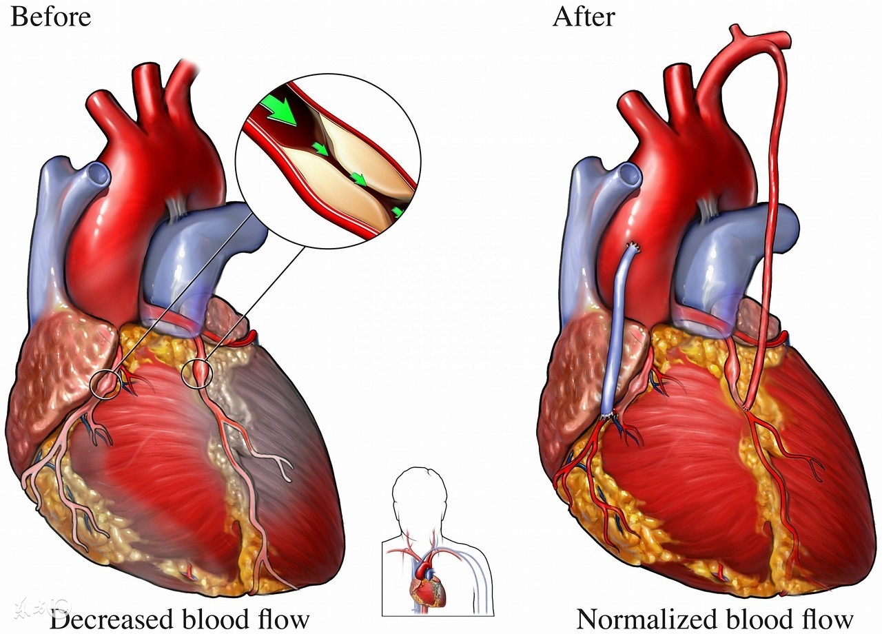 高血压可以补硒吗(一个肾可以补硒吗)-硒宝网