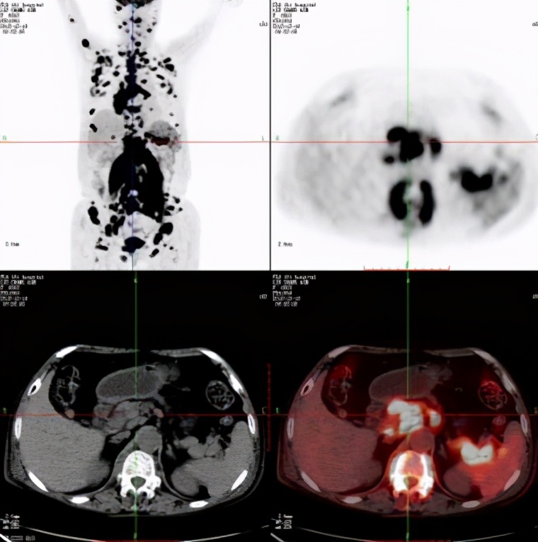 补硒对肺结节有效果吗（补硒对肺结节有好处吗）-硒宝网