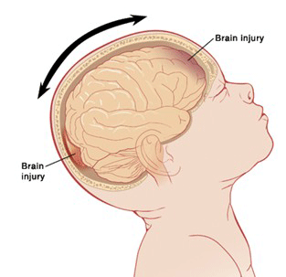 补硒会中毒吗（硒中毒后遗症）-硒宝网
