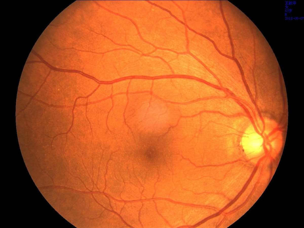 黄斑病变能补充硒吗（病变能补充黄斑硒素吗）-硒宝网