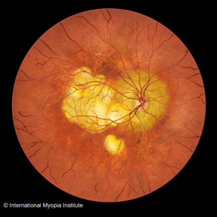 黄斑病变能补充硒吗(硒对黄斑病变有治疗作用吗)-硒宝网
