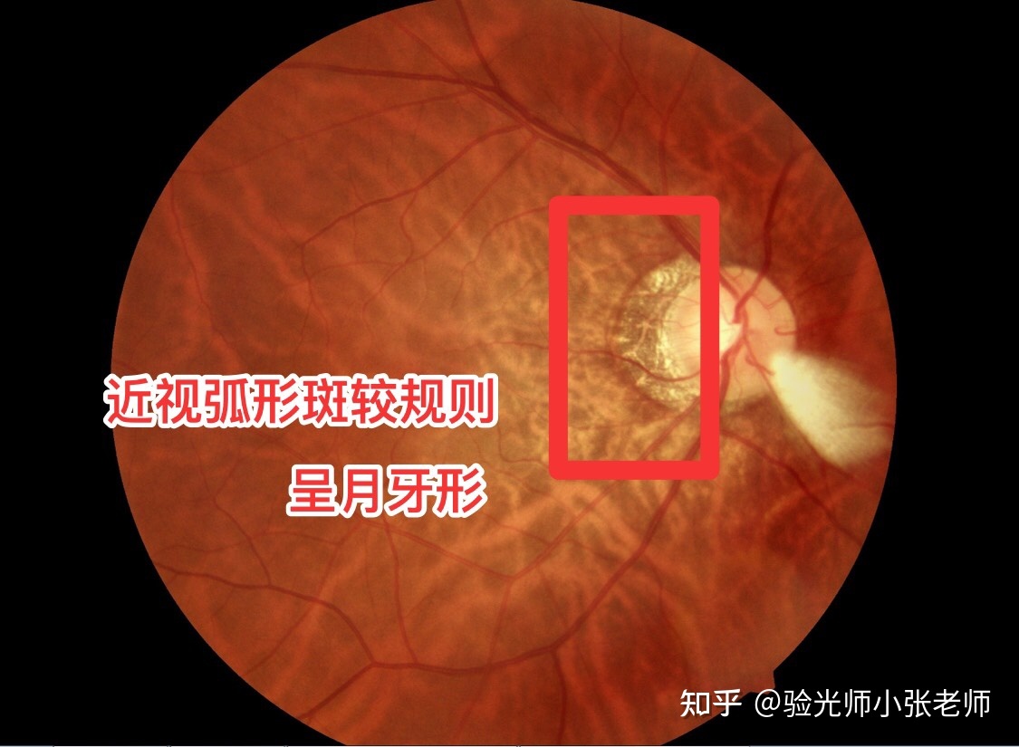 黄斑病变能补充硒吗(硒对黄斑病变有治疗作用吗)-硒宝网