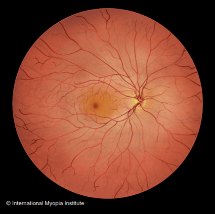 黄斑病变能补充硒吗(硒对黄斑病变有治疗作用吗)-硒宝网