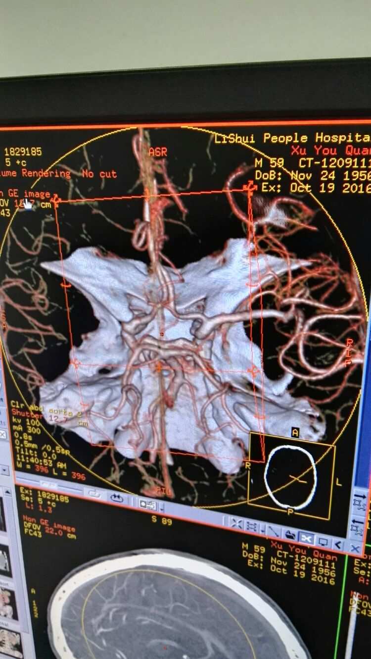 补硒对血压有什么好处(补硒降血压吗)-硒宝网