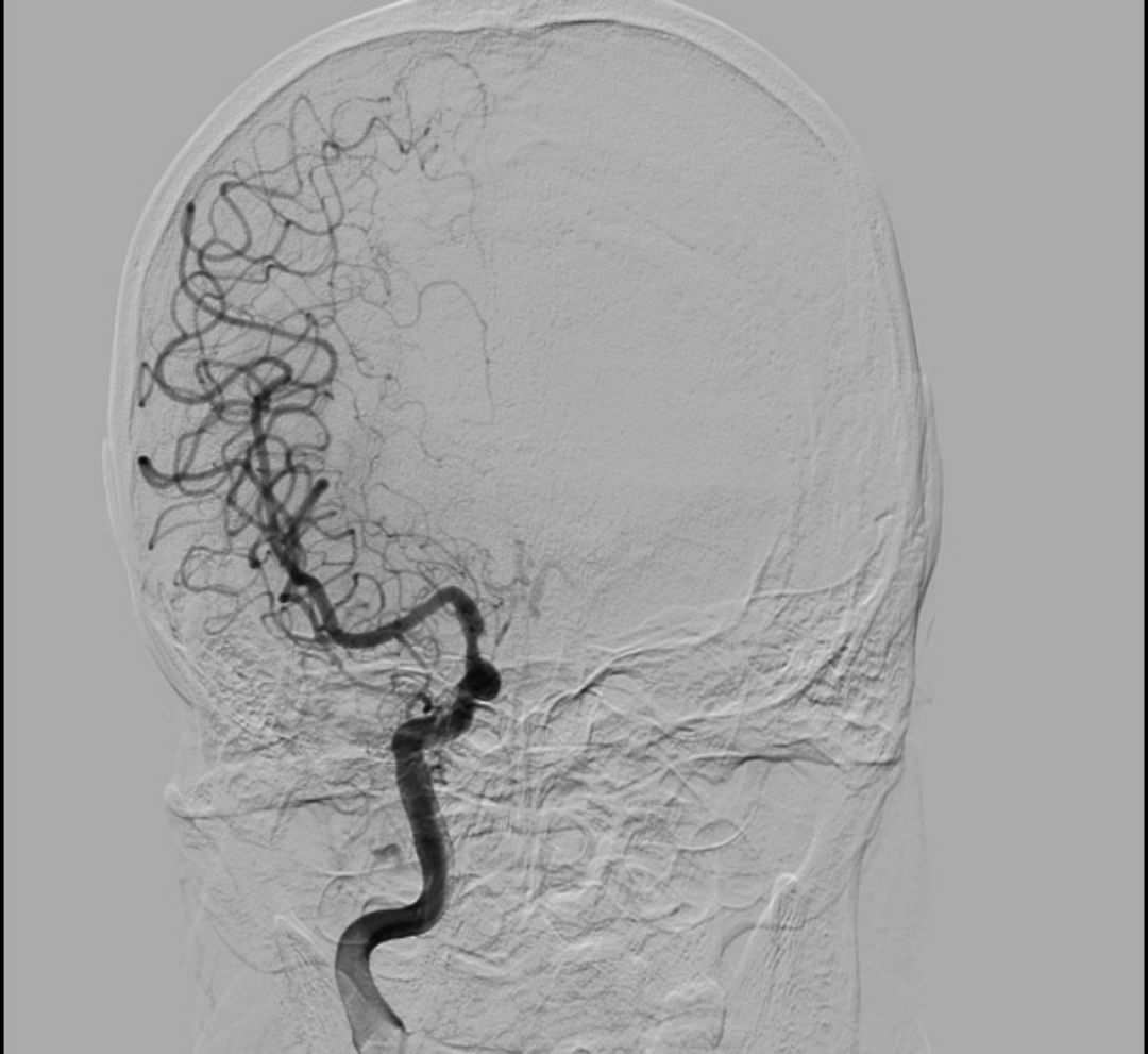 补硒对血压有什么好处(补硒降血压吗)-硒宝网