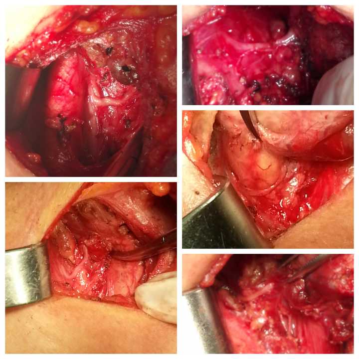 有甲状腺结节纯补硒吗（补甲状腺纯结节硒有效果吗）-硒宝网