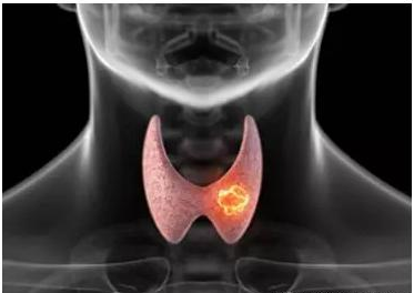 有甲状腺结节纯补硒吗（补甲状腺纯结节硒有效果吗）-硒宝网