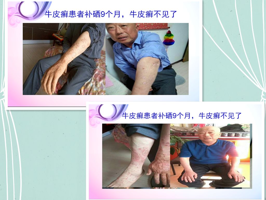 肝病患者补硒治愈视频(各个电视台补硒视频)-硒宝网