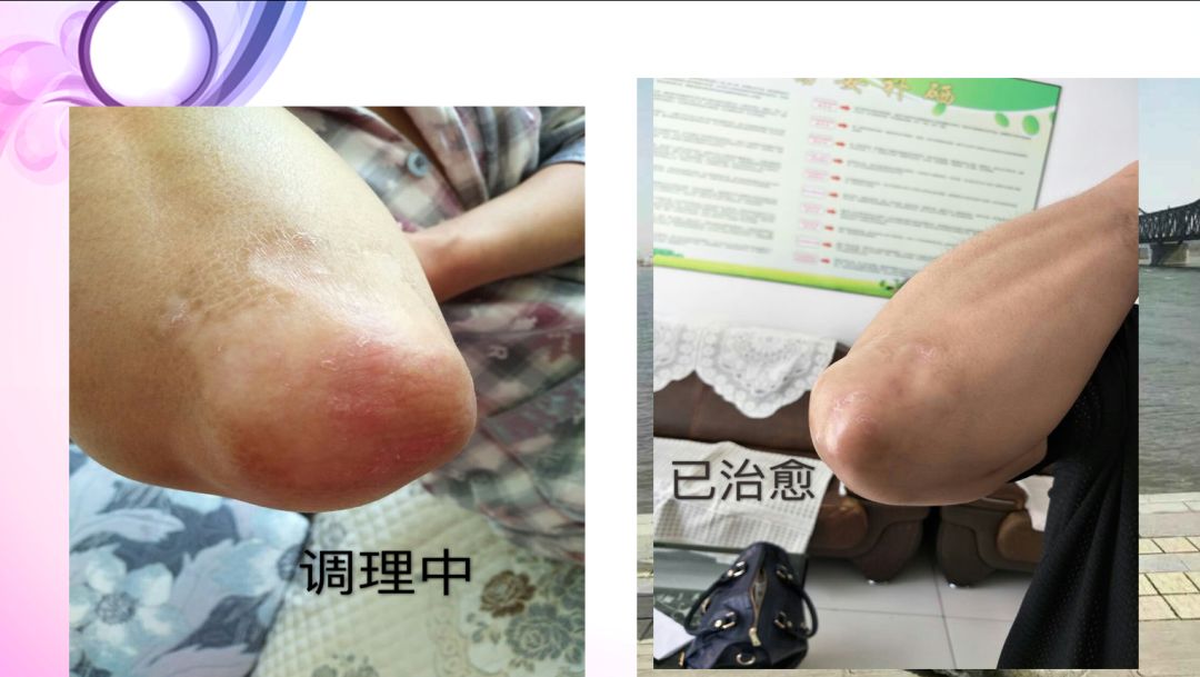 肝病患者补硒治愈视频(各个电视台补硒视频)-硒宝网