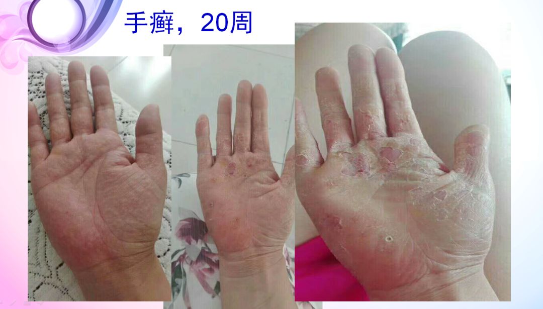 肝病患者补硒治愈视频(各个电视台补硒视频)-硒宝网