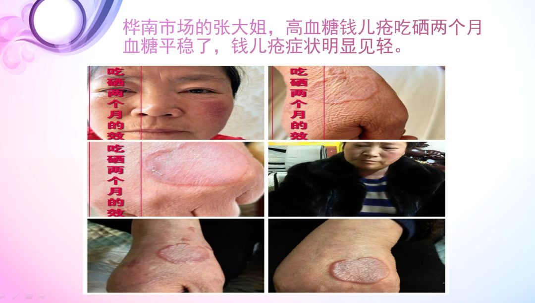 肝病患者补硒治愈视频(各个电视台补硒视频)-硒宝网