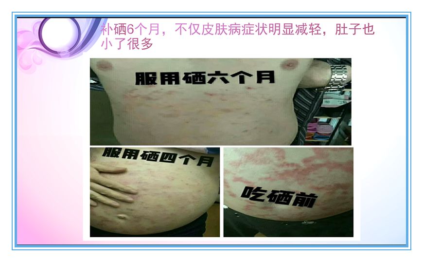 肝病患者补硒治愈视频(各个电视台补硒视频)-硒宝网