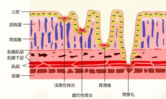 有胃糜烂病的怎样补硒(糜烂性胃炎可以吃硒酵母片吗)-硒宝网