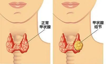 甲状腺肿要补碘还是硒（甲状腺吃补硒的药）-硒宝网