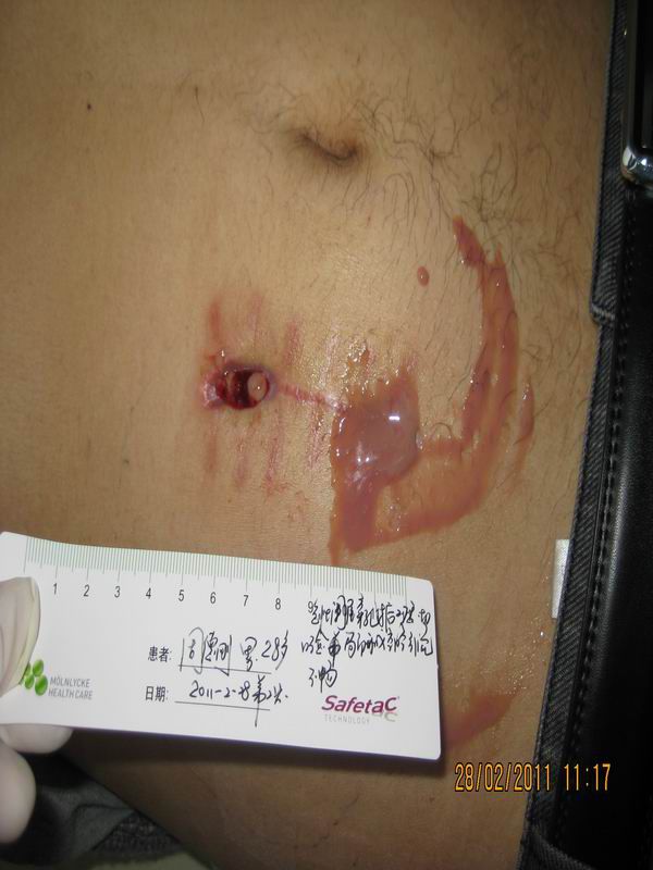 补硒后为什么乳房疼呢（乳房疼补硒后不疼了）-硒宝网