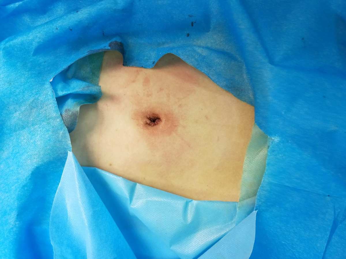 阑尾炎打针需要补硒吗(阑尾炎输液吃什么食物)-硒宝网