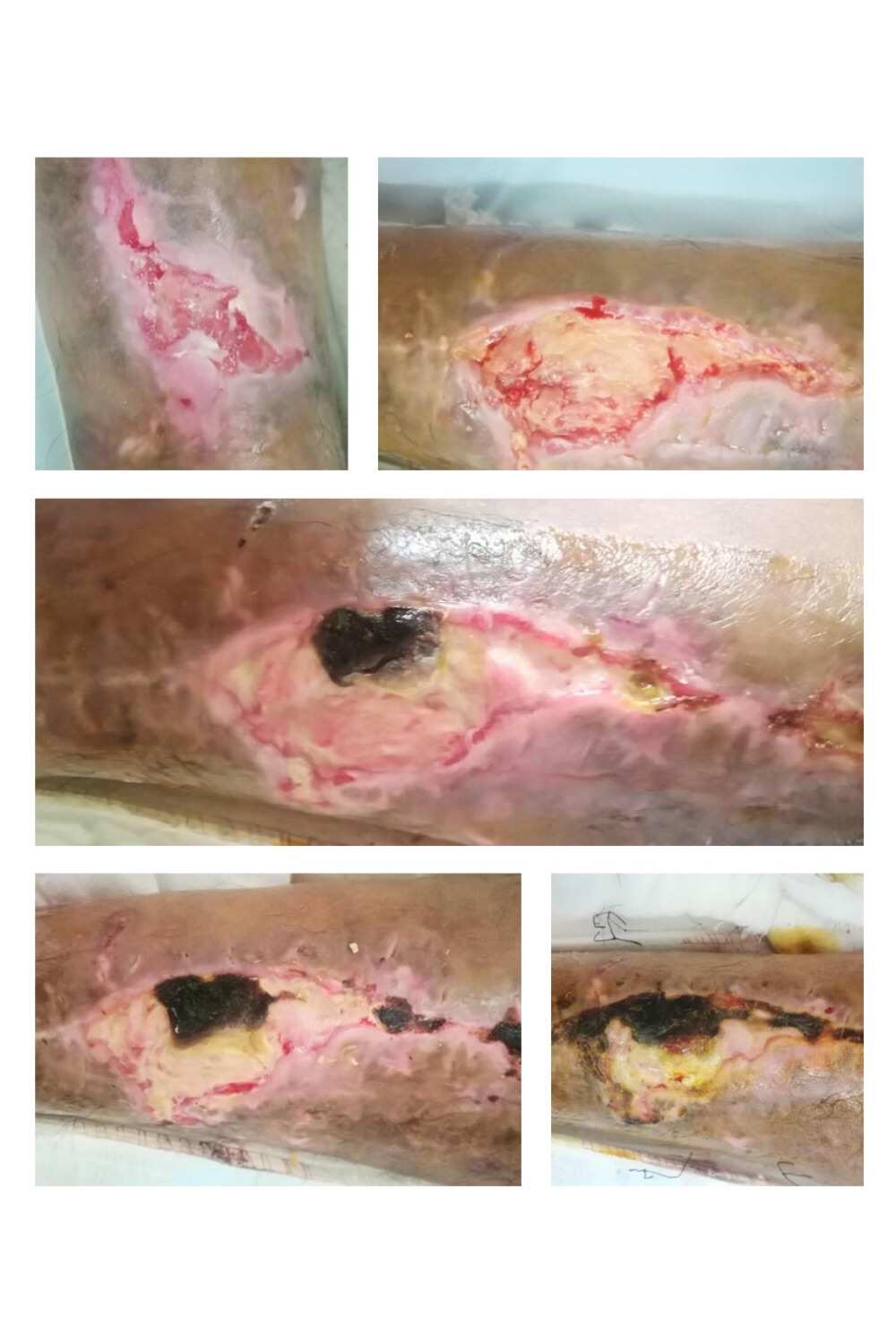 阑尾炎打针需要补硒吗(阑尾炎输液吃什么食物)-硒宝网