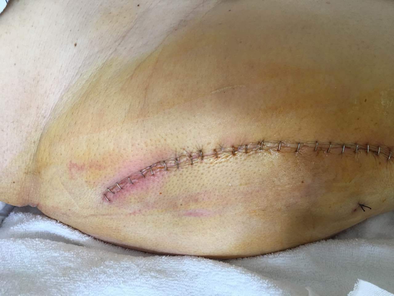 阑尾炎打针需要补硒吗(阑尾炎输液吃什么食物)-硒宝网