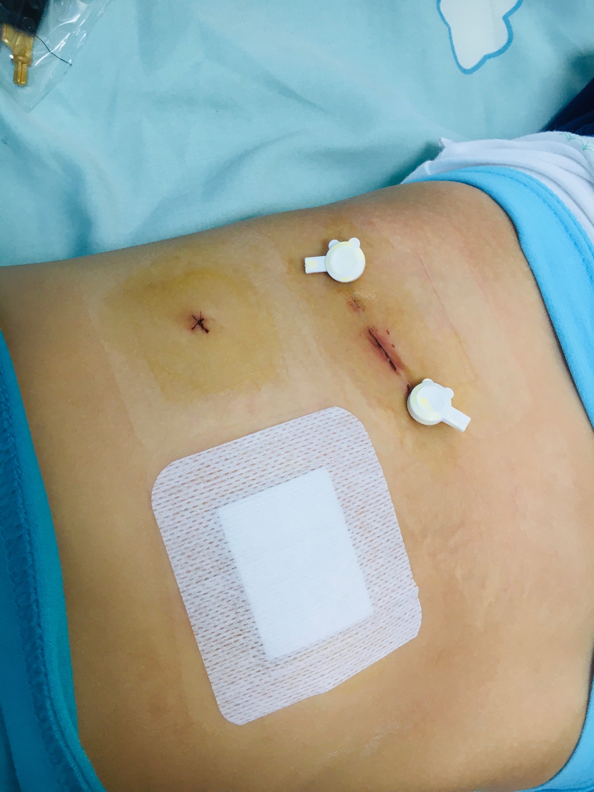 阑尾炎打针需要补硒吗(阑尾炎输液吃什么食物)-硒宝网