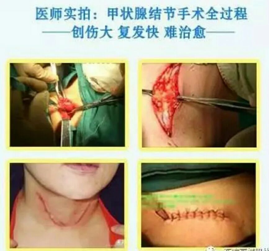 甲状腺结节补硒补多久(补甲状腺结节硒的作用)-硒宝网