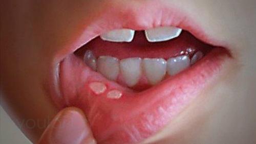 口腔溃疡补硒还是补鼻(口腔溃疡补硒起到什么作用)-硒宝网