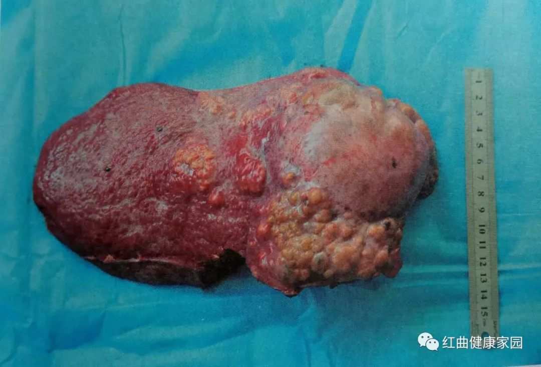 癌症患者怎么适当补硒（癌症患者怎样补硒好）-硒宝网