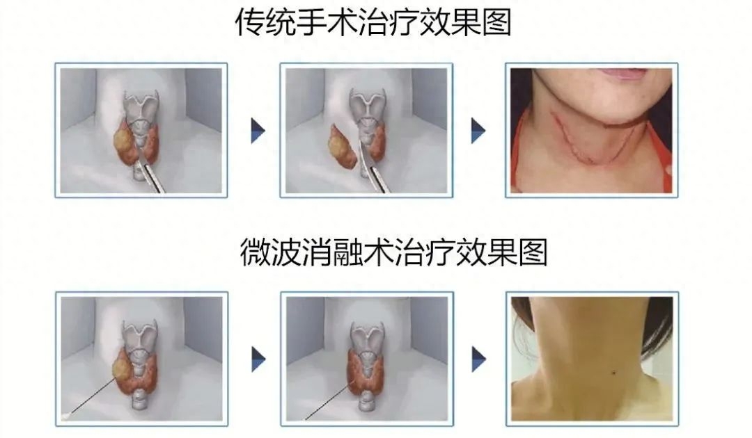 甲亢每天补硒多少毫克（每天补甲亢硒多少克）-硒宝网