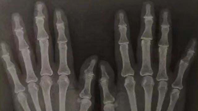 甲状腺补硒食物有哪些(补甲状腺食物硒有什么作用)-硒宝网