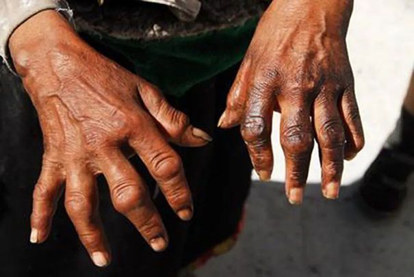 人体补硒每天最低多少(缺硒地区的人应该天天补硒吗)-硒宝网