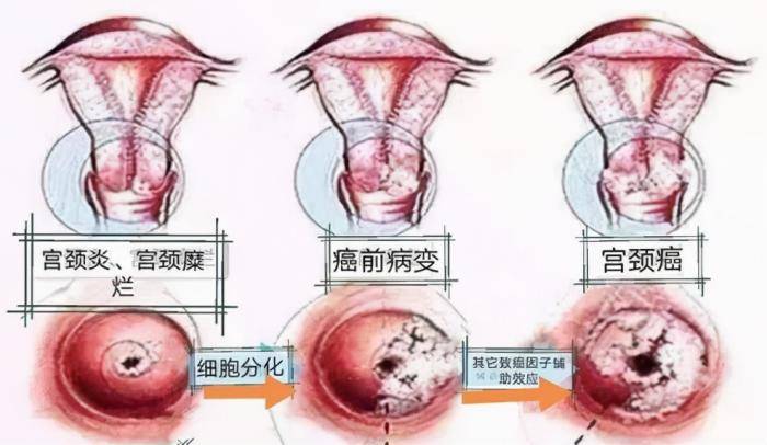 hpv感染补哪种类硒(感染hpv补硒有用吗)-硒宝网