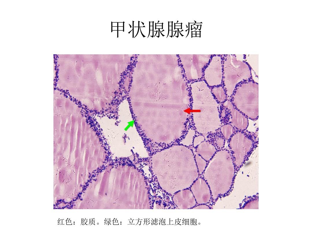 甲状腺结节是否要补硒（甲状腺结节补硒有什好处）-硒宝网