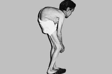 肾衰病人能否大量补硒(吃硒治疗肾衰竭)-硒宝网