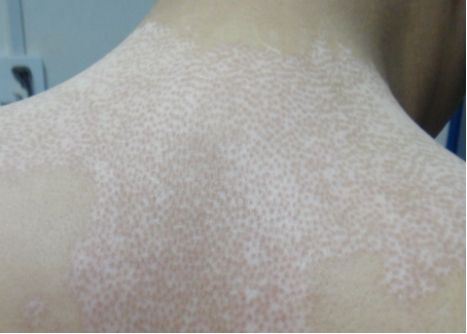 白癜风人群可以补硒吗(孕妇可以补硒吗)-硒宝网