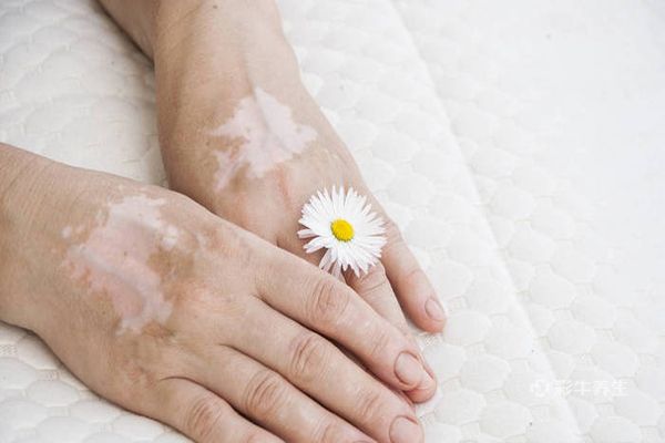 白癜风人群可以补硒吗(孕妇可以补硒吗)-硒宝网