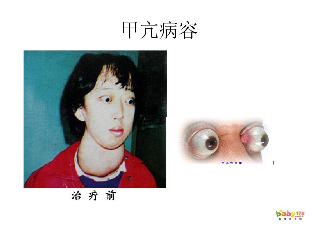 补硒和甲状腺功能亢进（补甲状腺功能亢进硒片有用吗）-硒宝网