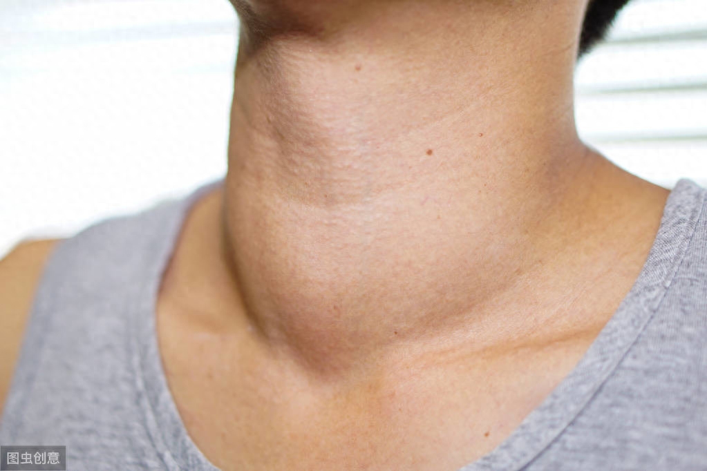 补硒会得甲状腺结节吗（甲状腺结节多发性结节）-硒宝网