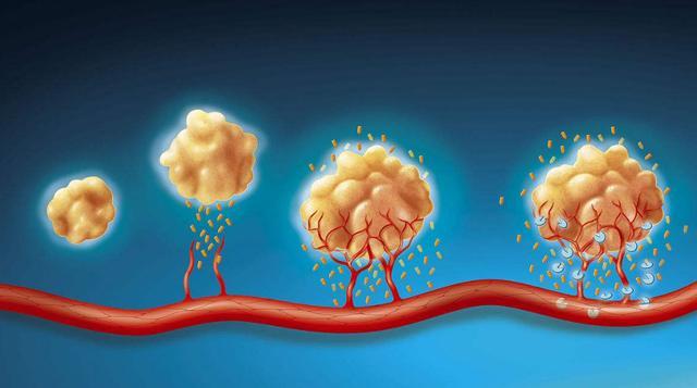 癌症患者补硒康复案例（癌症患者补硒实例）-硒宝网