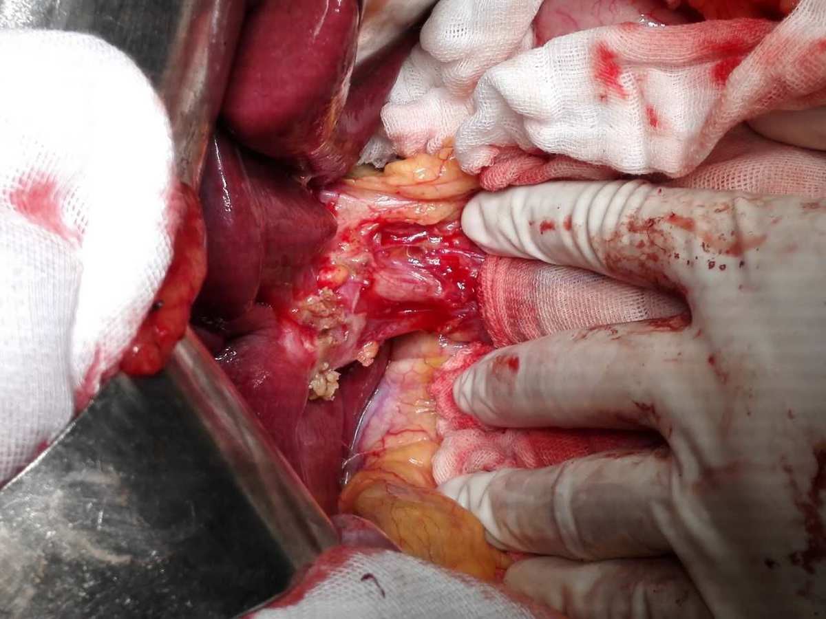 胃癌化疗期间补硒食物（胃癌补硒有用吗）-硒宝网