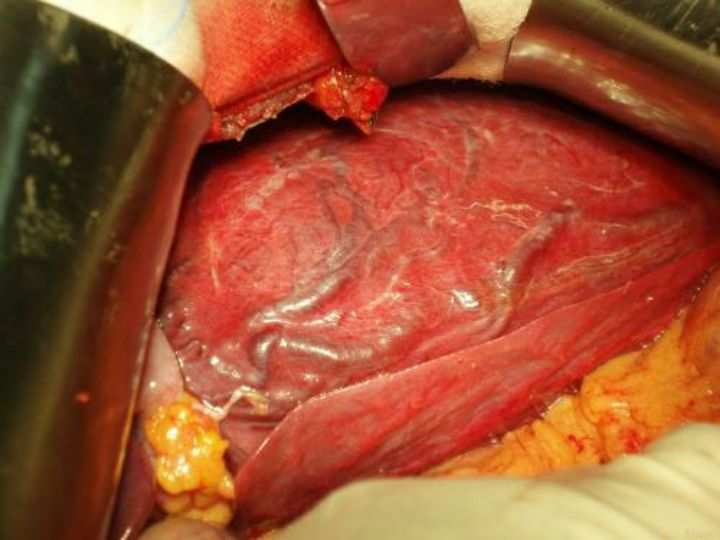 肝硬化患者补什么硒好(肝硬化吃富硒有什么好处)-硒宝网