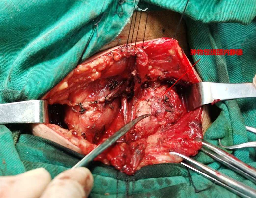 甲状腺癌术后怎么补硒（甲状腺癌手术后可以吃硒吗）-硒宝网