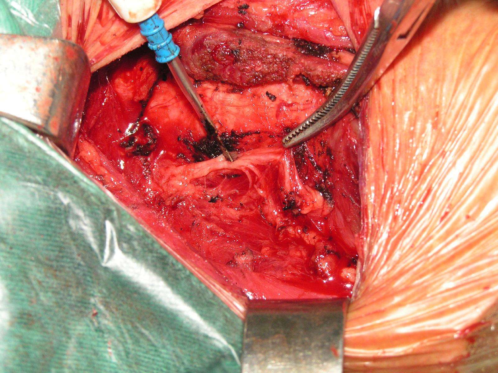 甲状腺癌术后怎么补硒（甲状腺癌手术后可以吃硒吗）-硒宝网