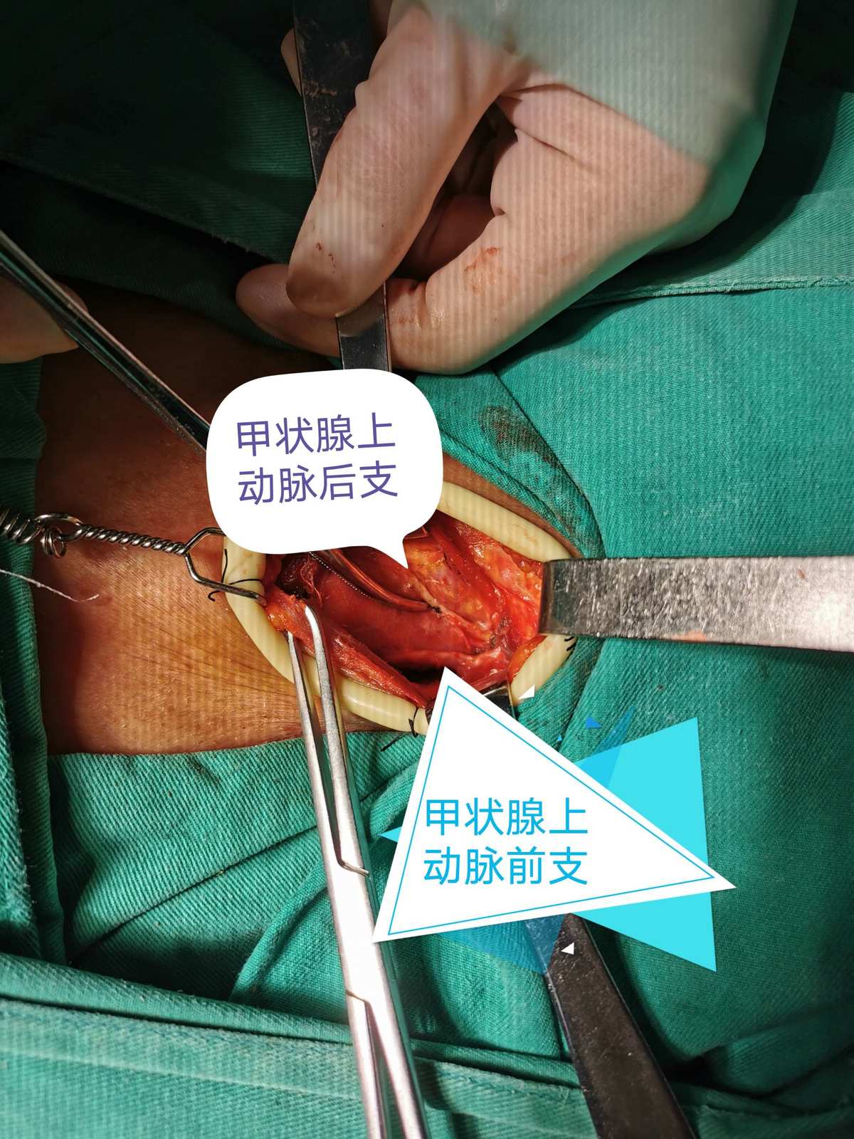 甲状腺癌术后怎么补硒（甲状腺癌手术后可以吃硒吗）-硒宝网