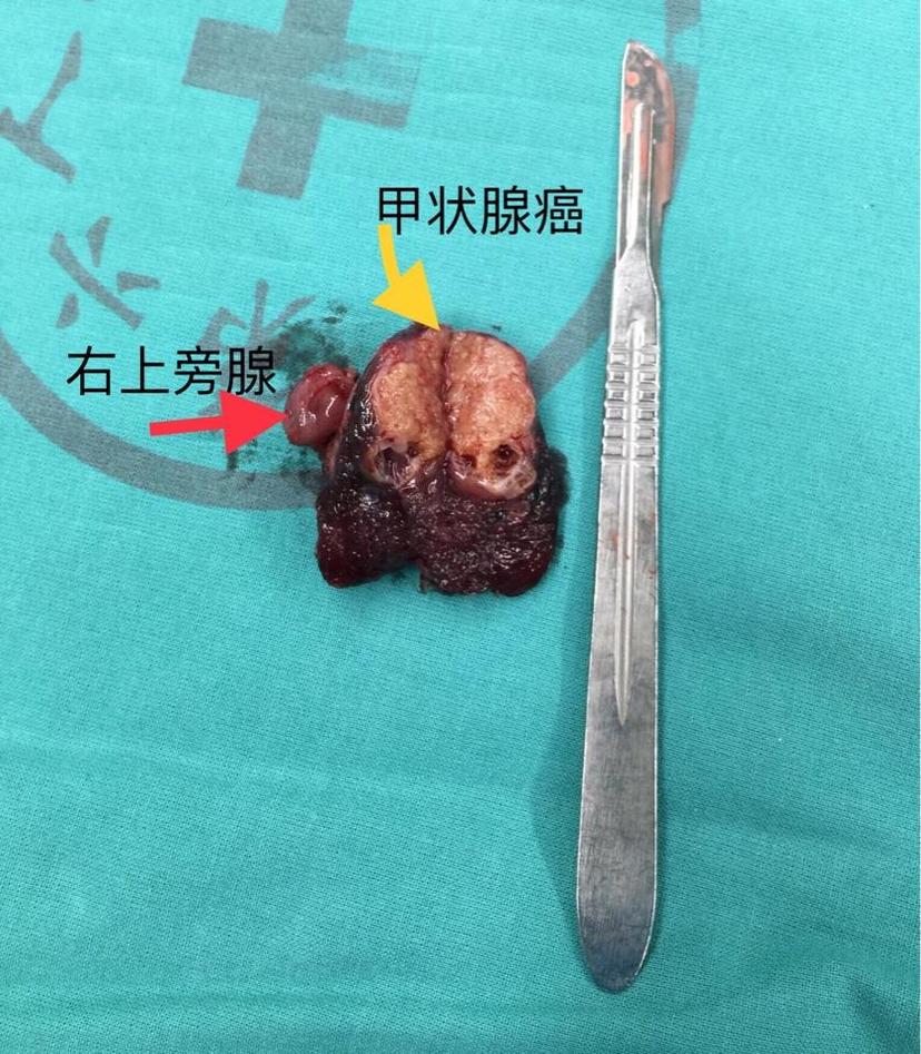 甲状腺癌术后怎么补硒(癌术补甲状腺硒后吃什么好)-硒宝网