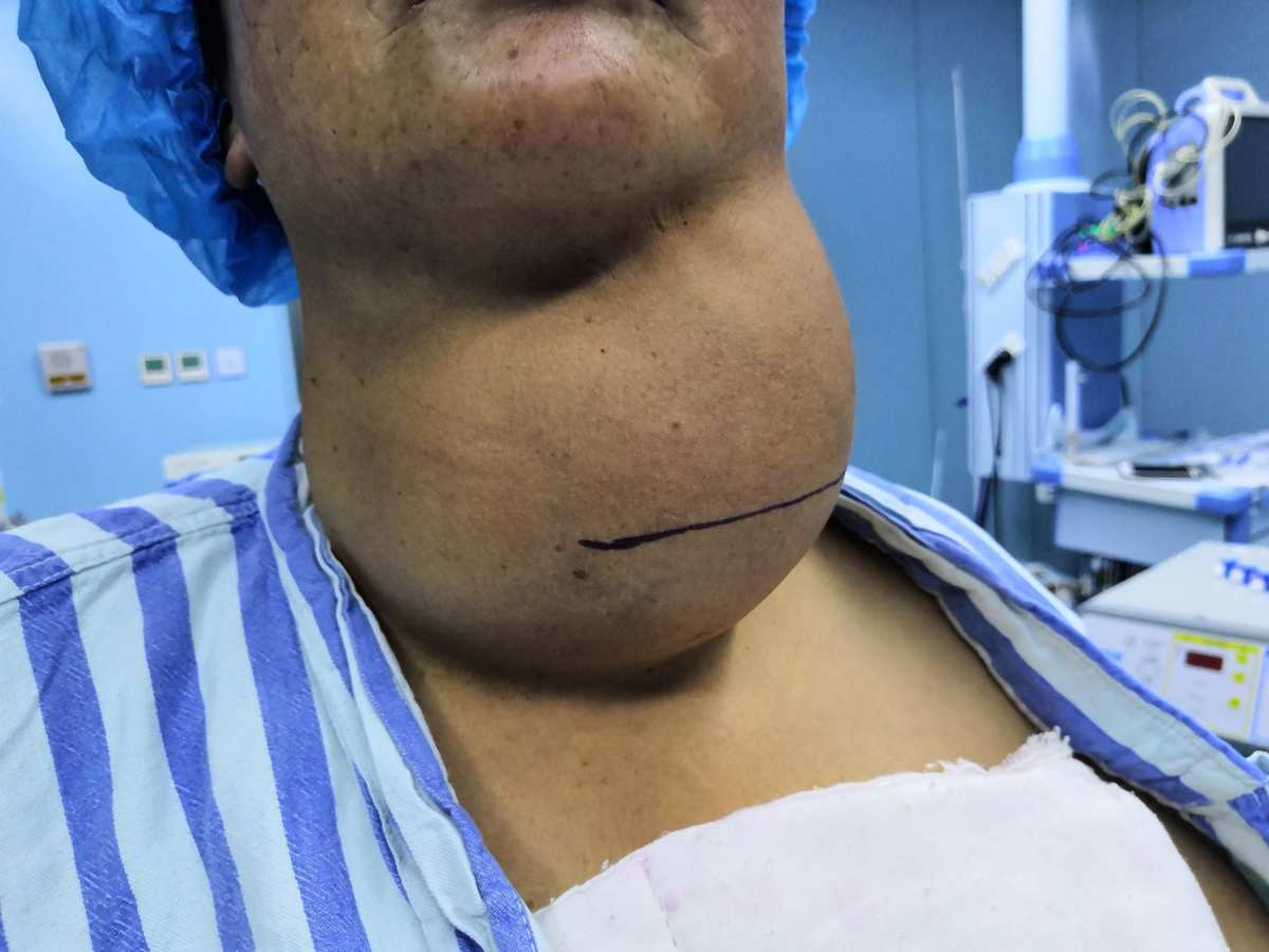 甲状腺癌术后怎么补硒(癌术补甲状腺硒后吃什么好)-硒宝网