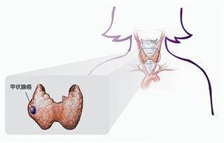甲状腺癌术后怎么补硒(癌术补甲状腺硒后吃什么好)-硒宝网