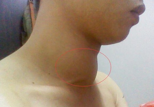 甲状腺肿块可以补硒吗(补甲状腺肿块硒可以吗)-硒宝网