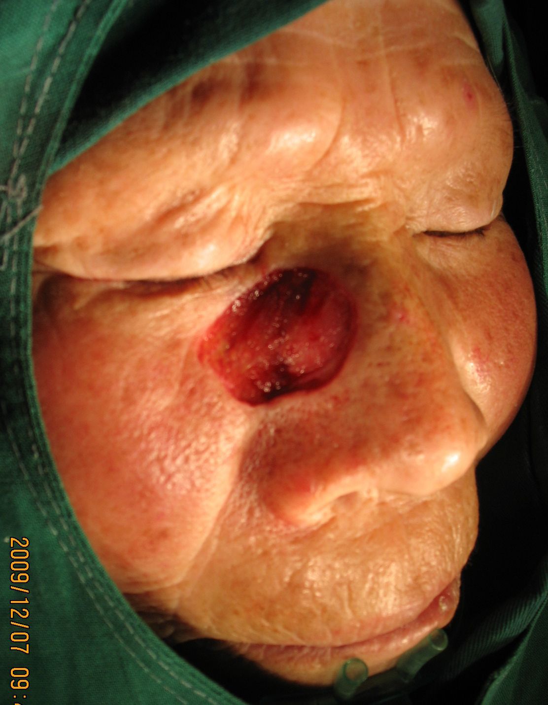 原位癌术后需要补硒吗（原位癌术后要吃药吗）-硒宝网