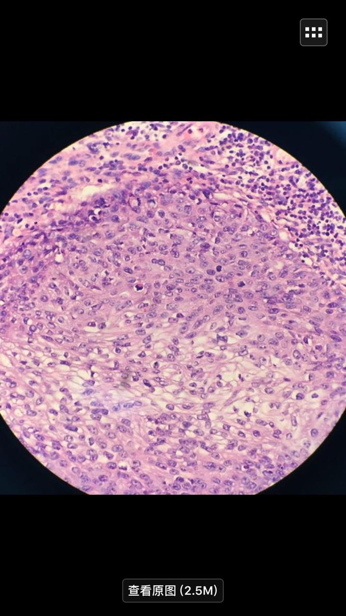 原位癌术后需要补硒吗（原位癌术后要吃药吗）-硒宝网