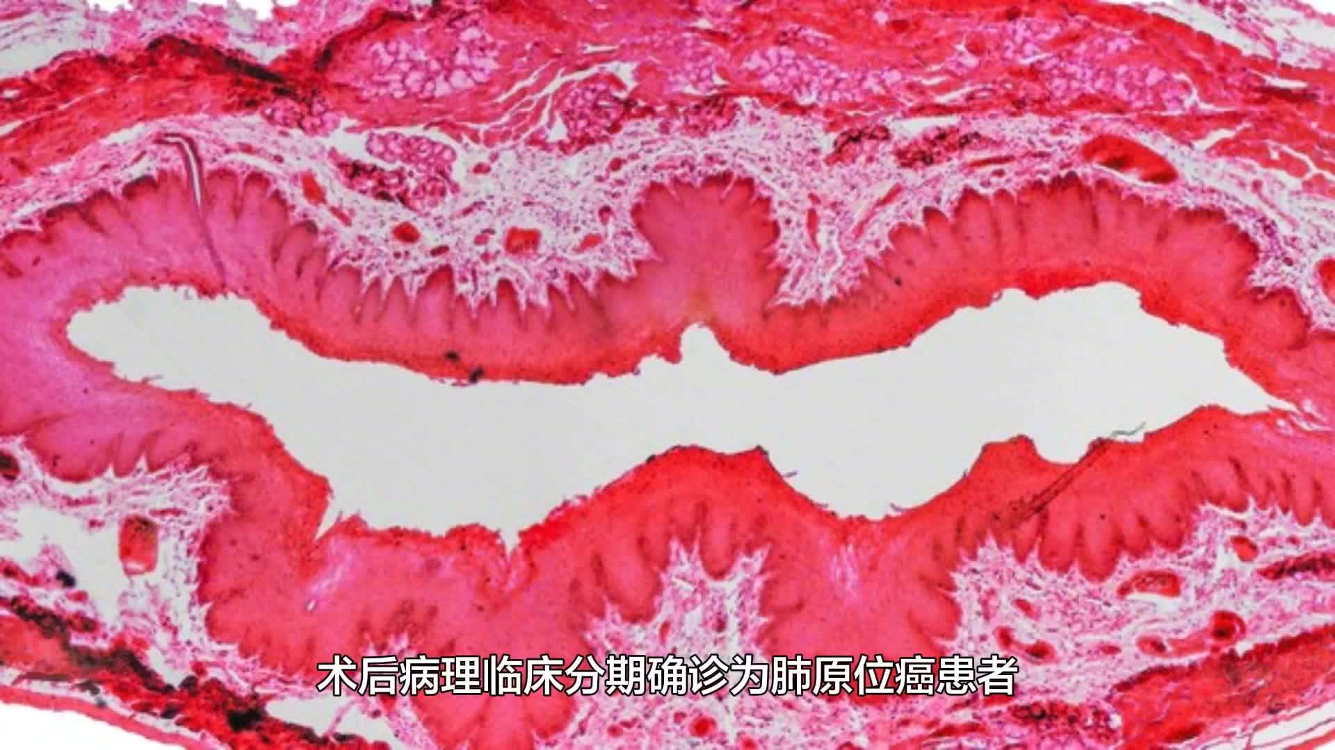 原位癌术后需要补硒吗（原位癌术后要吃药吗）-硒宝网